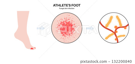 Athletes foot inflammation 132200840