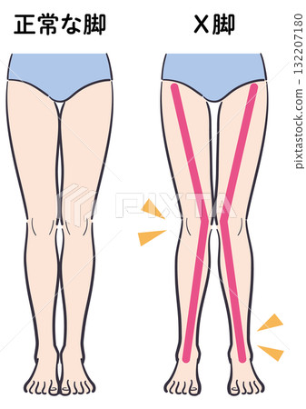 正常腿型與膝蓋內翻腿型的比較圖（附輔助線） 132207180