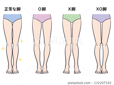 正常腿與羅圈腿、弓形腿和膝內翻腿的比較圖 132207183