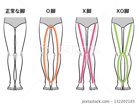 正常腿與 O 型腿、O 型腿、XO 型腿的比較圖(附輔助線/線圖類型) 正常腿與 O 型腿、O 型腿、XO 型腿的比較圖(附輔助線/線圖類型) 132207185