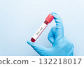 Blood sample tube with PSA test on medical laboratory technologist hands over blue background. A blood test that measures the level of prostate specific antigen to screen for prostate cancer. 132218017