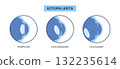 Ectopia lentis disease 132235614