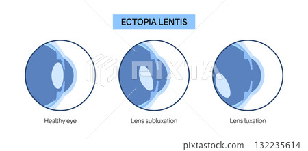 Ectopia lentis disease 132235614