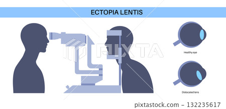 Ectopia lentis disease 132235617