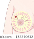 Breast Cancer Stage I (1st Stage) Easy-to-understand illustration Breast Cancer Stage I (1st Stage) Easy-to-understand illustration 132240632