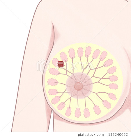 乳癌 I 期(第一階段)簡單易懂的插圖 乳癌 I 期(第一階段)簡單易懂的插圖 132240632