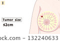Breast Cancer Stage I (1st Stage) Easy-to-understand English illustrations Breast Cancer Stage I (1st Stage) Easy-to-understand English illustrations 132240633