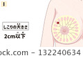 Breast Cancer Stage I (1st Stage) Easy-to-understand Japanese illustrations Breast Cancer Stage I (1st Stage) Easy-to-understand Japanese illustrations 132240634
