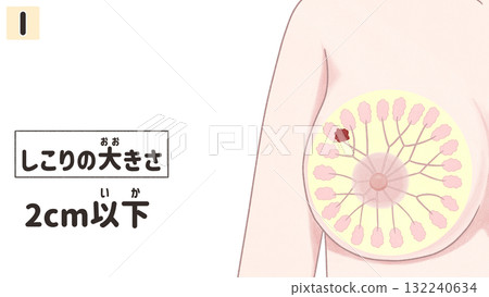 乳癌I期(第1期)簡單易懂的日文插圖 乳癌I期(第1期)簡單易懂的日文插圖 132240634