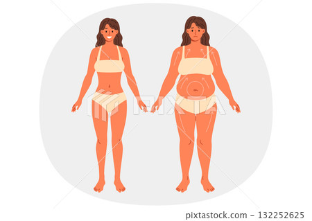 Liposuction for overweight beautiful woman posing in underwear before and after surgery 132252625