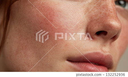 Close up of irritated skin on female face with redness and rosacea Close up of irritated skin on female face with redness and rosacea 132252936