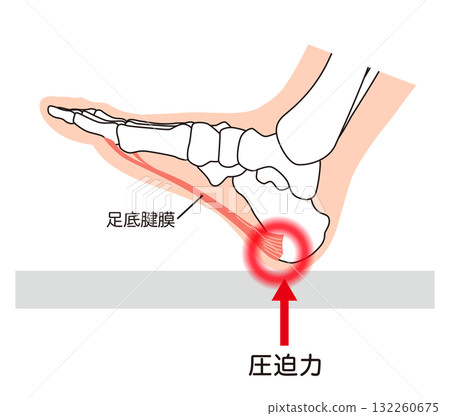 足底筋膜炎、足底筋膜、足底腱膜、足部肌肉 足底筋膜炎、足底筋膜、足底腱膜、足部肌肉 132260675