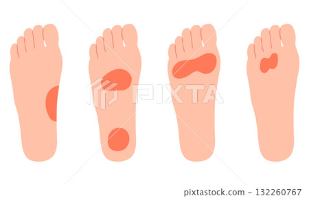 Pain in the soles of the feet - Inflammation 132260767