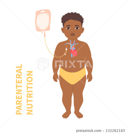 Child receiving parenteral nutrition through a central intravenous access 132262183
