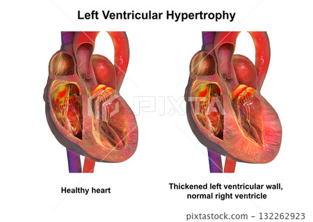 Left ventricular hypertrophy, 3D illustration Left ventricular hypertrophy, 3D illustration 132262923