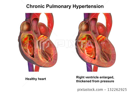 Right ventricular hypertrophy and dilation, 3D illustration 132262925