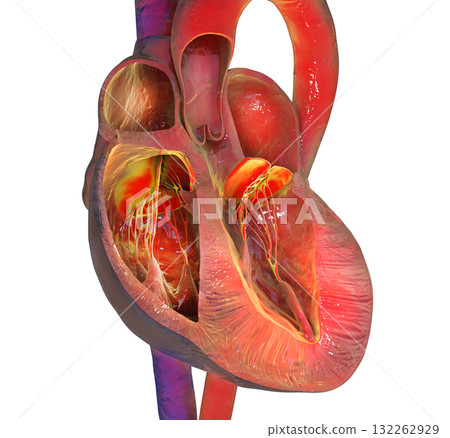 Left ventricular hypertrophy, 3D illustration 132262929