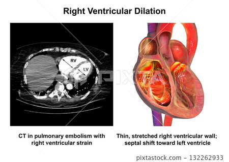 Right ventricular dilation, 3D illustration with CT scan 132262933
