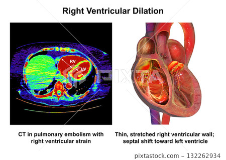 Right ventricular dilation, 3D illustration with CT scan 132262934