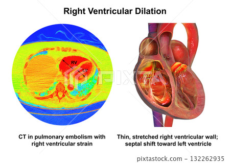 Right ventricular dilation, 3D illustration with CT scan 132262935