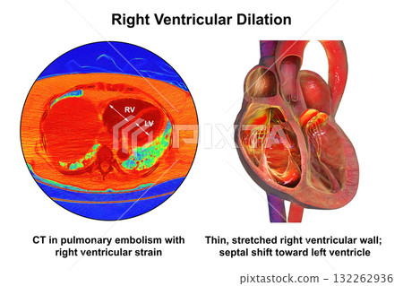 Right ventricular dilation, 3D illustration with CT scan 132262936