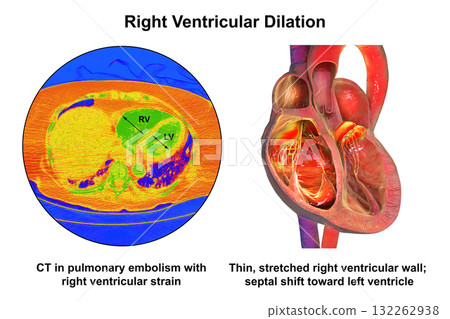 Right ventricular dilation, 3D illustration with CT scan 132262938