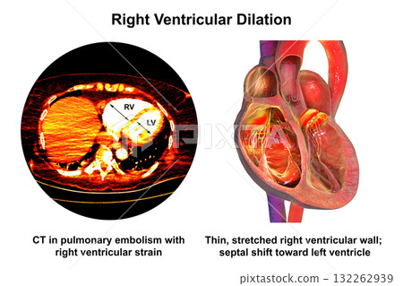 Right ventricular dilation, 3D illustration with CT scan 132262939