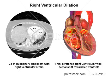 Right ventricular dilation, 3D illustration with CT scan 132262940