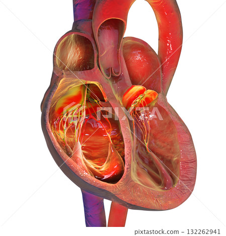 Right ventricular dilation, 3D illustration 132262941