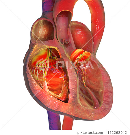 Right ventricular hypertrophy and dilation, 3D illustration 132262942