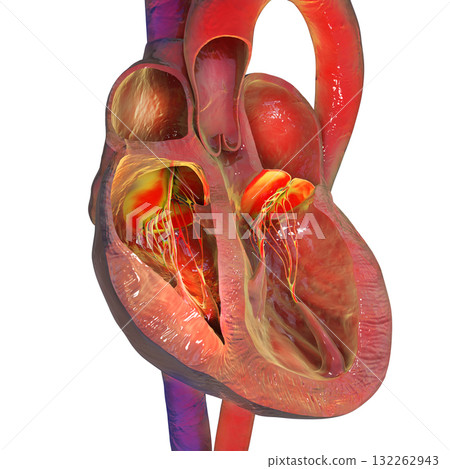 Right ventricular hypertrophy, 3D illustration. 132262943