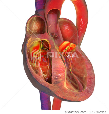 Heart with septal hypertrophy, 3D illustration 132262944