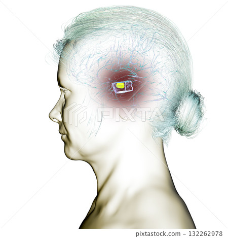 Human brain with degenerated substantia nigra in Parkinson's disease, 3D illustration 132262978