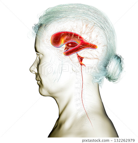 Normal pressure hydrocephalus, 3D illustration 132262979