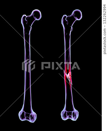 Femur bone with shaft fracture, 3D illustration Femur bone with shaft fracture, 3D illustration 132262994