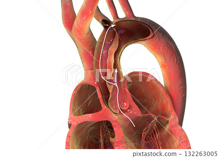 Ascending aortic dissection, 3D illustration Ascending aortic dissection, 3D illustration 132263005