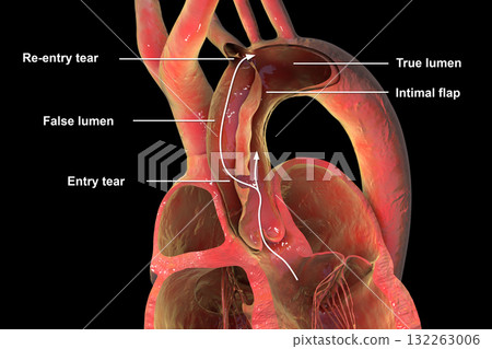 Ascending aortic dissection, 3D illustration 132263006