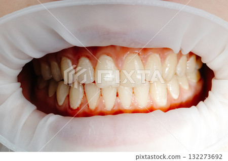 Dentist examining patient teeth using cheek retractor during dental procedure 132273692