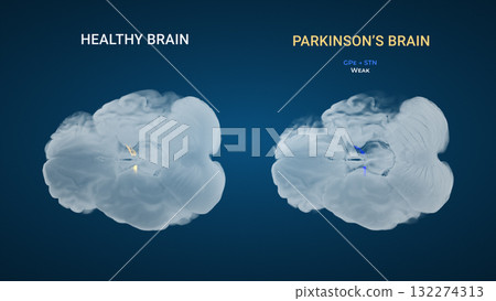 Parkinsons GPe STN Weak Indirect Pathway Comparison 132274313