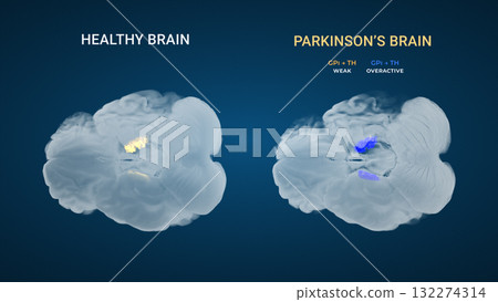 Parkinsons GPi Thalamic Output Imbalance Comparison 132274314