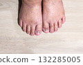 Cancer chemotherapy cause swelling of ankles (ankle oedema) ,  skin to become dry, dark or peel and nails brittle or flaky. 132285005