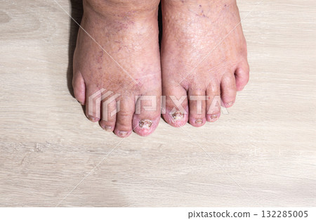 Cancer chemotherapy cause swelling of ankles (ankle oedema) , skin to become dry, dark or peel and nails brittle or flaky. Cancer chemotherapy cause swelling of ankles (ankle oedema) , skin to become dry, dark or peel and nails brittle or flaky. 132285005