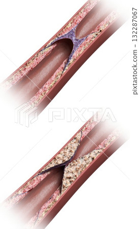 Healthy vs Atherosclerotic Coronary Artery Comparison Healthy vs Atherosclerotic Coronary Artery Comparison 132287067