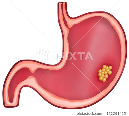 Stomach Cancer, Hand-drawn Watercolor Illustration 132291415