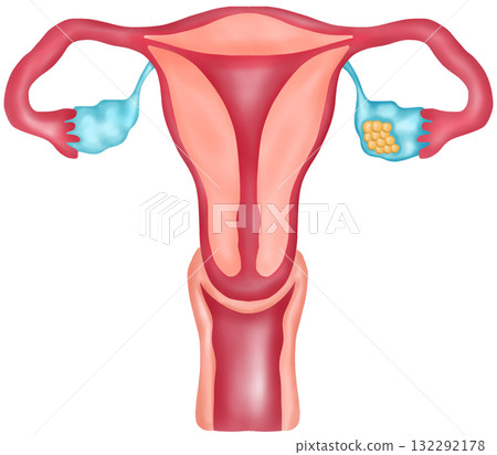 Ovarian Cancer, Hand-drawn Watercolor Illustration Ovarian Cancer, Hand-drawn Watercolor Illustration 132292178