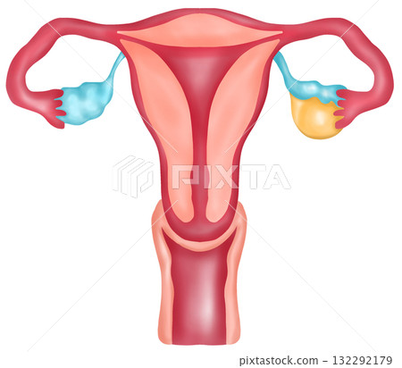 Female Reproductive System with Ovarian Cyst, Hand-drawn Watercolor Illustration Female Reproductive System with Ovarian Cyst, Hand-drawn Watercolor Illustration 132292179