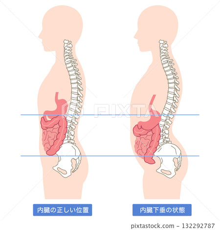內臟下垂:內臟器官下垂的一種狀況 內臟下垂:內臟器官下垂的一種狀況 132292787