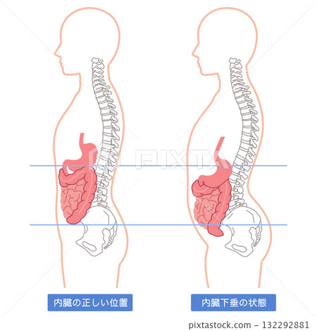 內臟下垂:內臟器官下垂的一種狀況 內臟下垂:內臟器官下垂的一種狀況 132292881