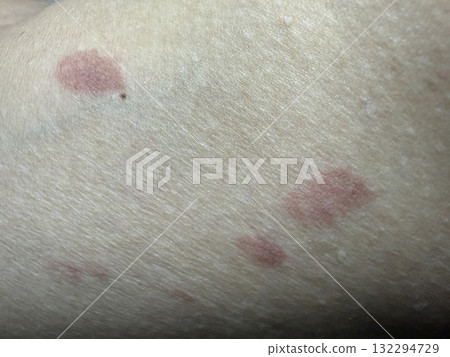 Red spots on the human body, burns, bacteria, infections. Medicine, treatment, self-treatment. Red spots on the human body, burns, bacteria, infections. Medicine, treatment, self-treatment. 132294729