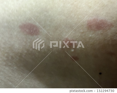 Red spots on the human body, burns, bacteria, infections. Medicine, treatment, self-treatment. Red spots on the human body, burns, bacteria, infections. Medicine, treatment, self-treatment. 132294730